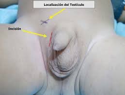 Criptorquidia: Cuando los testículos no bajan